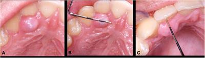 Peripheral calcifying odontogenic cyst: a case report and comprehensive review of 60 years of literature